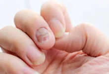 5 Effective Natural Remedies for Psoriatic Arthritis Nails – YesTablets