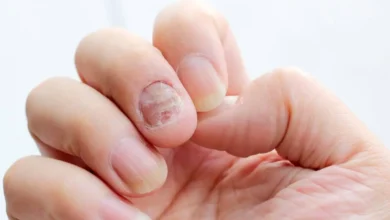 5 Effective Natural Remedies for Psoriatic Arthritis Nails – YesTablets