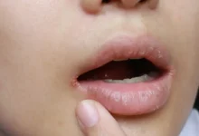 Close-up of a person's lower face showing painful chapped lips with a visible sore on the lower lip. Home Remedies for Mouth Sore