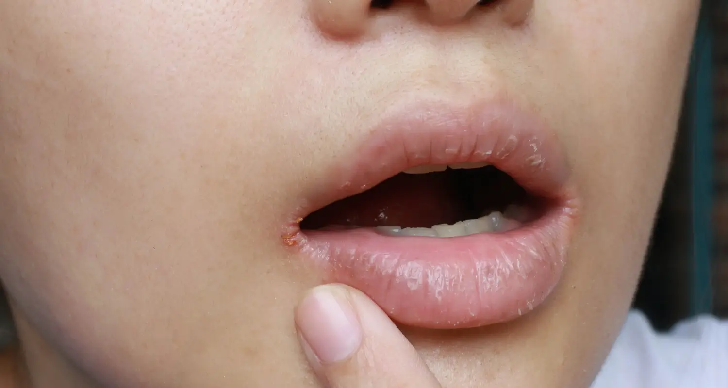 Close-up of a person's lower face showing painful chapped lips with a visible sore on the lower lip. Home Remedies for Mouth Sore