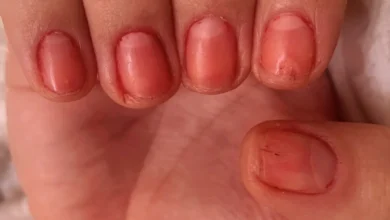Risk factors for developing herpes on nails – YesTablets