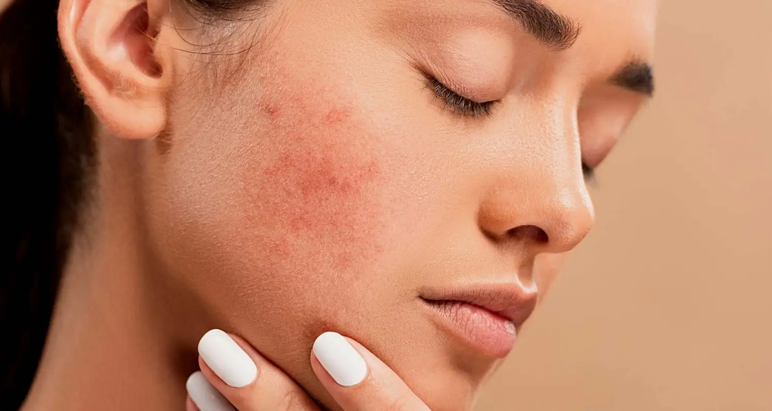 What causes mottling of the skin